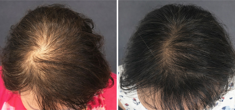 laser hair growth before after 1 laser hair growth before after 1