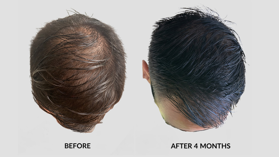 laser hair growth before after 2 laser hair growth before after 2